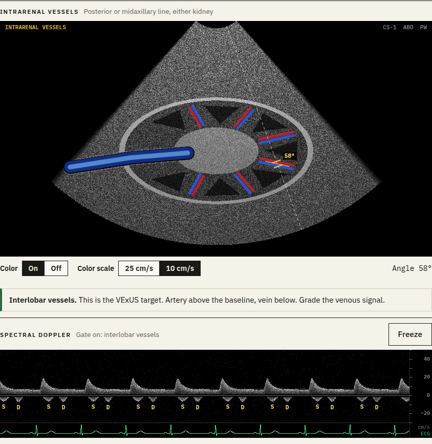 Acquire mode: a generated kidney image with color Doppler, the Doppler gate on an interlobar vessel, and the artery and vein trace it records